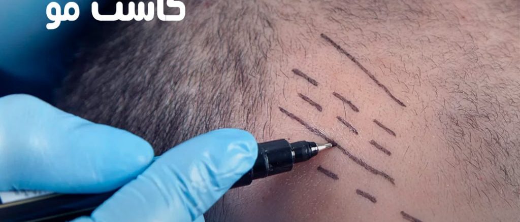 خدمات کاشت مو: روش‌ها، مزایا و هر آنچه باید بدانید