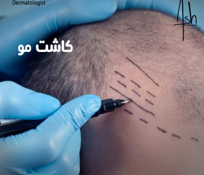 خدمات کاشت مو: روش‌ها، مزایا و هر آنچه باید بدانید