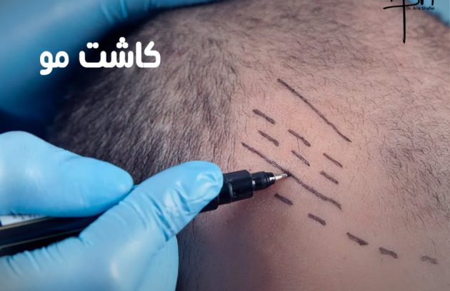 خدمات کاشت مو: روش‌ها، مزایا و هر آنچه باید بدانید