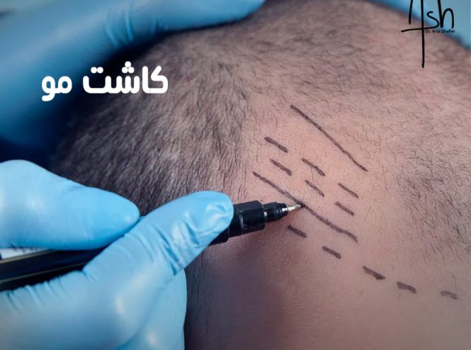 خدمات کاشت مو: روش‌ها، مزایا و هر آنچه باید بدانید